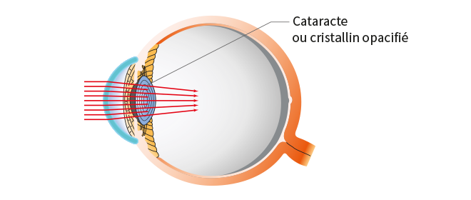 Opération Cataracte et Myopie