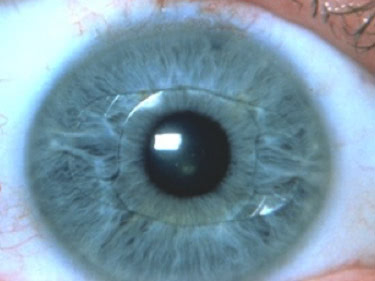 Implants Oculaires Artisan Artiflex - Chirurgie Forte Myopie