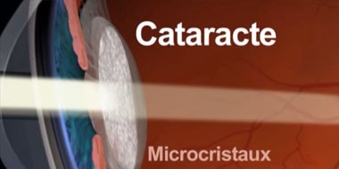 Cataracte Définition - Qu'est ce que la cataracte ?