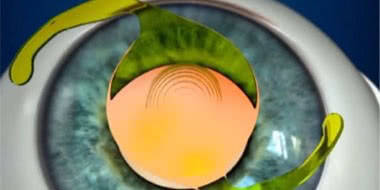 Chirurgie Cataracte Implant Multifocal