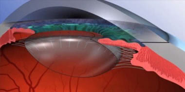 Opération Cataracte - Implant Oculaire