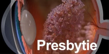 Presbytie Définition : Qu'est ce que la Presbytie ?