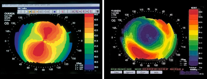 opération laser astigmatisme, chirurgie astigmastime