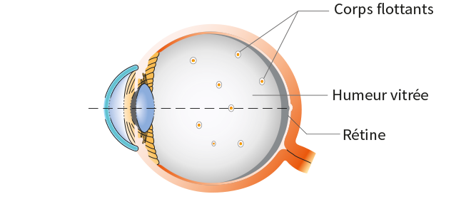 myopie, corps flottants yeux