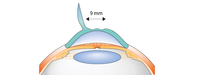 opération laser presbytie, Presbylasik