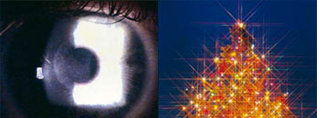 operation yeux laser excimer, traitement myopie laser