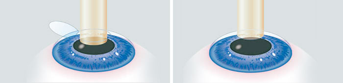 laser excimer, operation yeux laser
