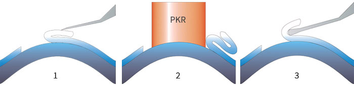 lasik lasek, chirurgie réfractive