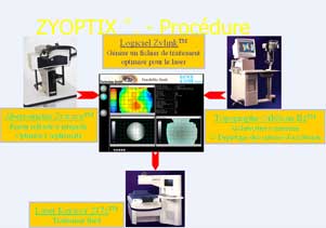 opération yeux laser, aberrométrie