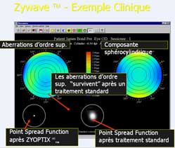 opération des yeux laser, aberrométrie